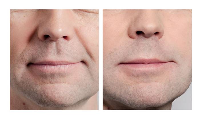 سریع‌ ترین روش درمان خط خنده